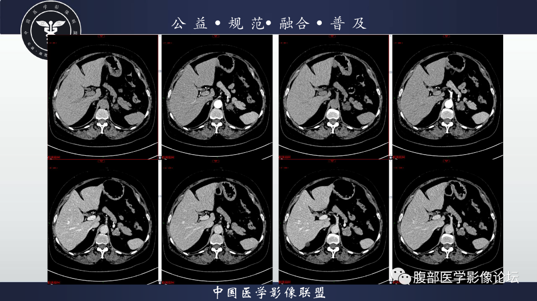 【病例】肾脏透明细胞癌1例CT影像-3