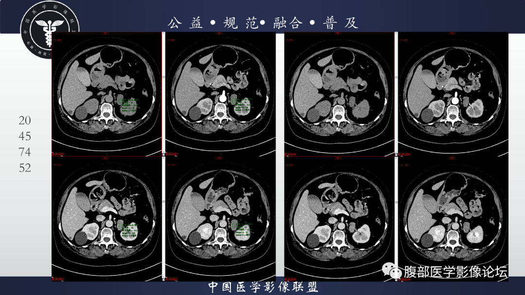 【病例】肾脏透明细胞癌1例CT影像-6