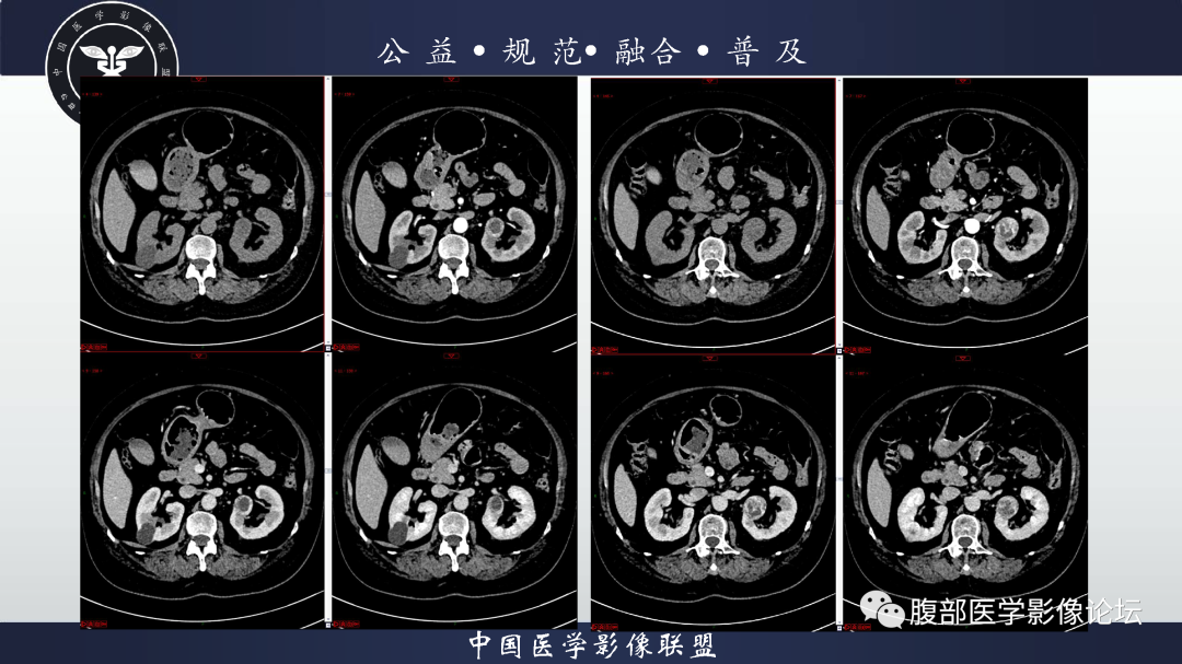【病例】肾脏透明细胞癌1例CT影像-7