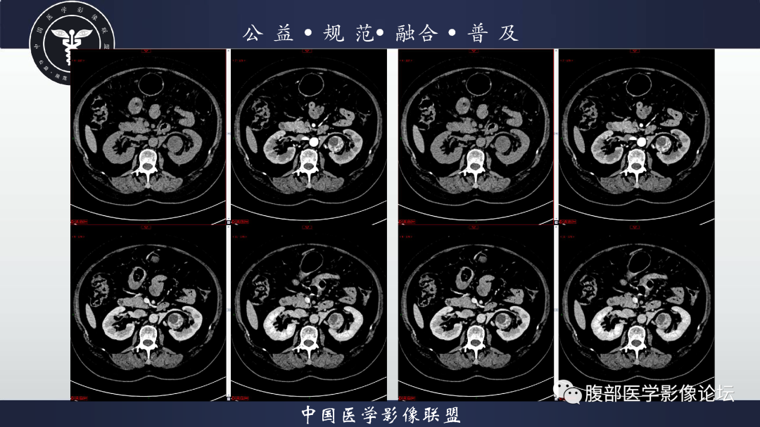 【病例】肾脏透明细胞癌1例CT影像-8