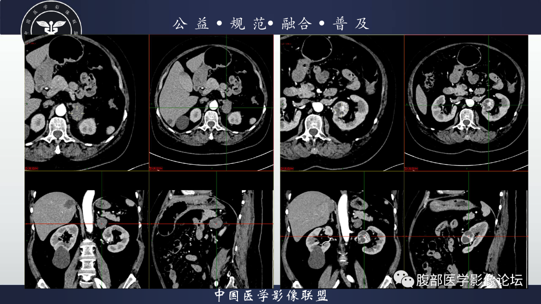 【病例】肾脏透明细胞癌1例CT影像-9
