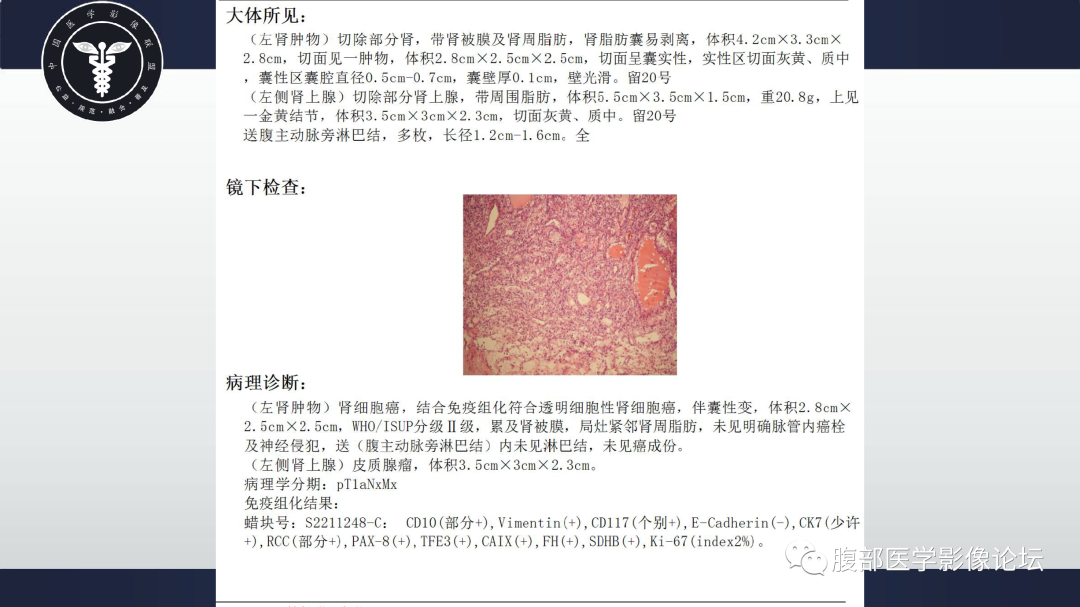 【病例】肾脏透明细胞癌1例CT影像-10