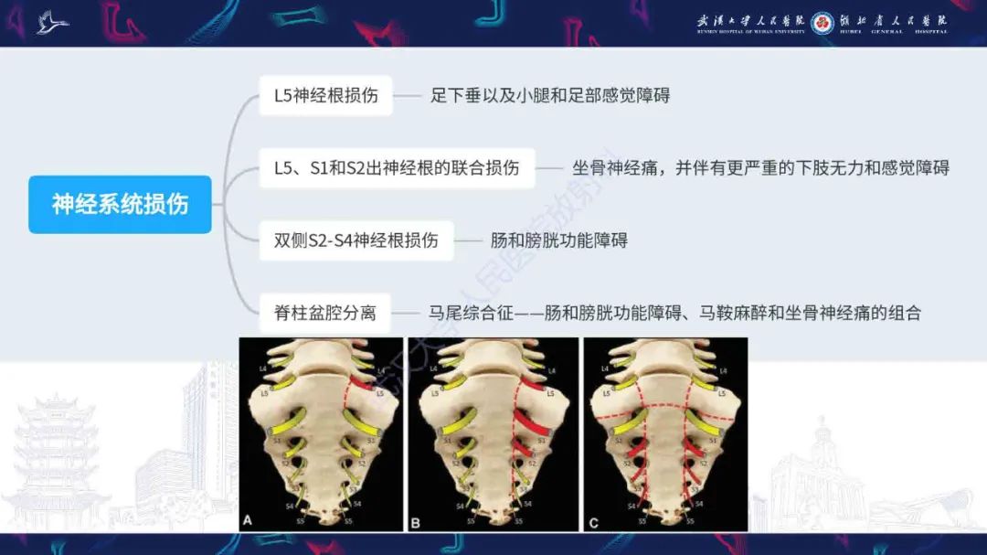 【PPT】骶骨骨折CT评估-6