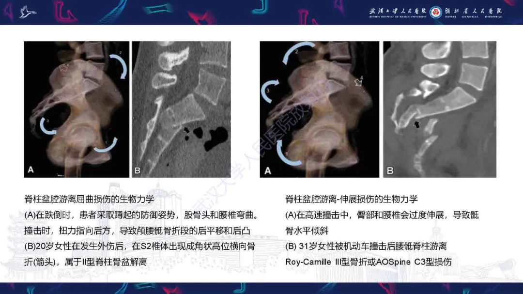 【PPT】骶骨骨折CT评估-14