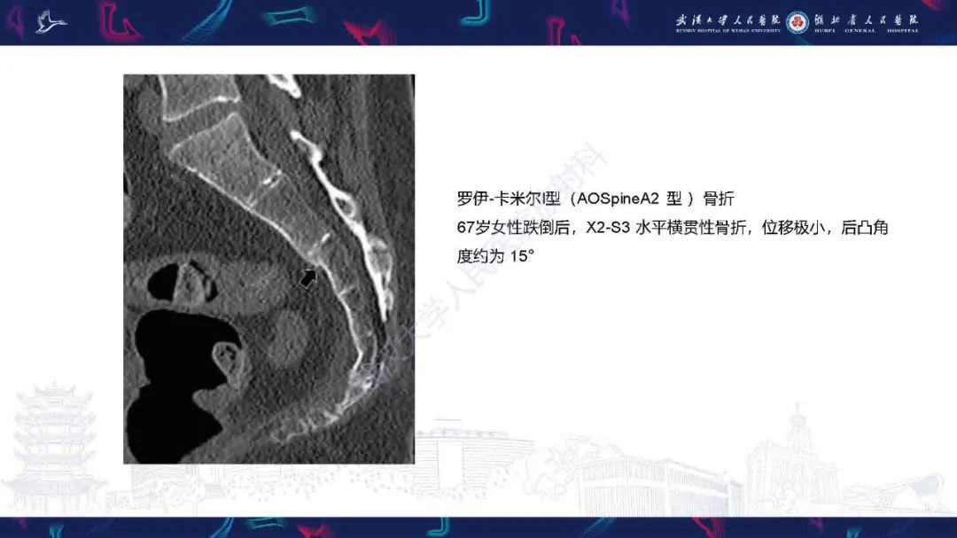 【PPT】骶骨骨折CT评估-13