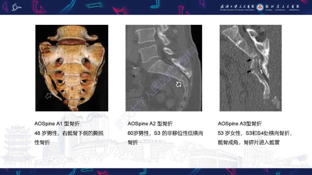 【PPT】骶骨骨折CT评估-19