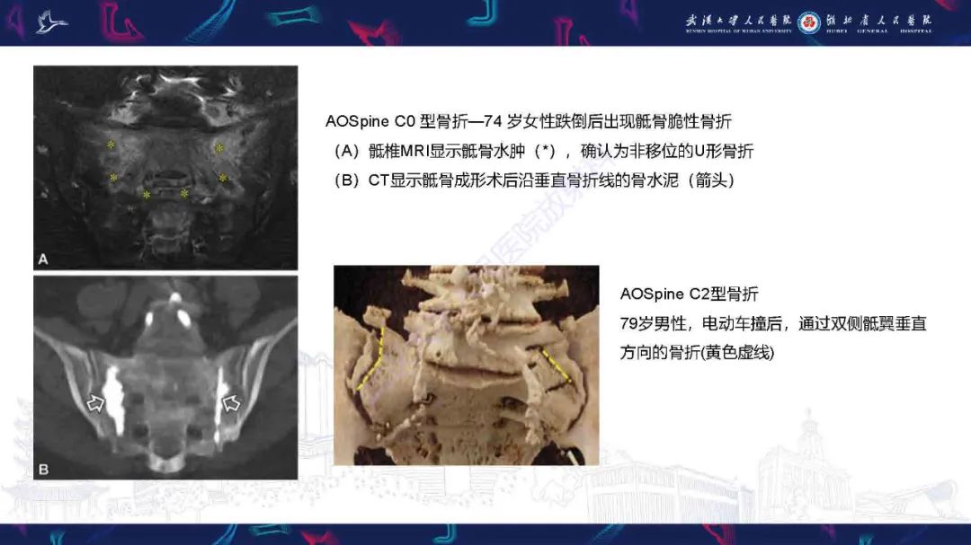 【PPT】骶骨骨折CT评估-20