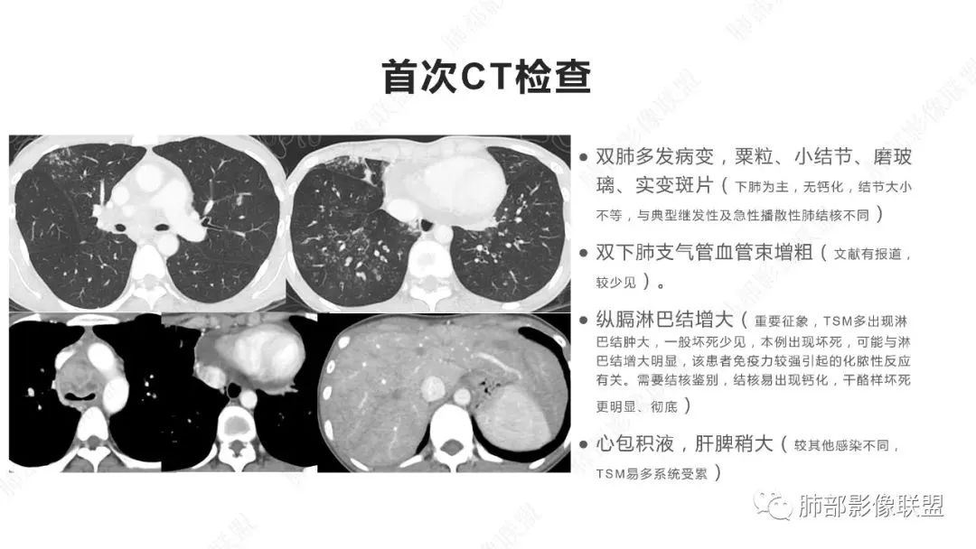 【PPT】马尔尼菲篮状菌的CT表现-3