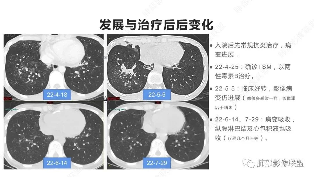 【PPT】马尔尼菲篮状菌的CT表现-4
