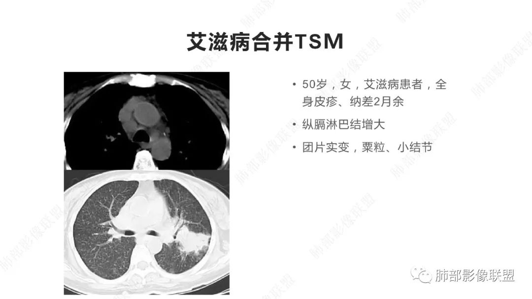 【PPT】马尔尼菲篮状菌的CT表现-9 【PPT】马尔尼菲篮状菌的CT表现-9