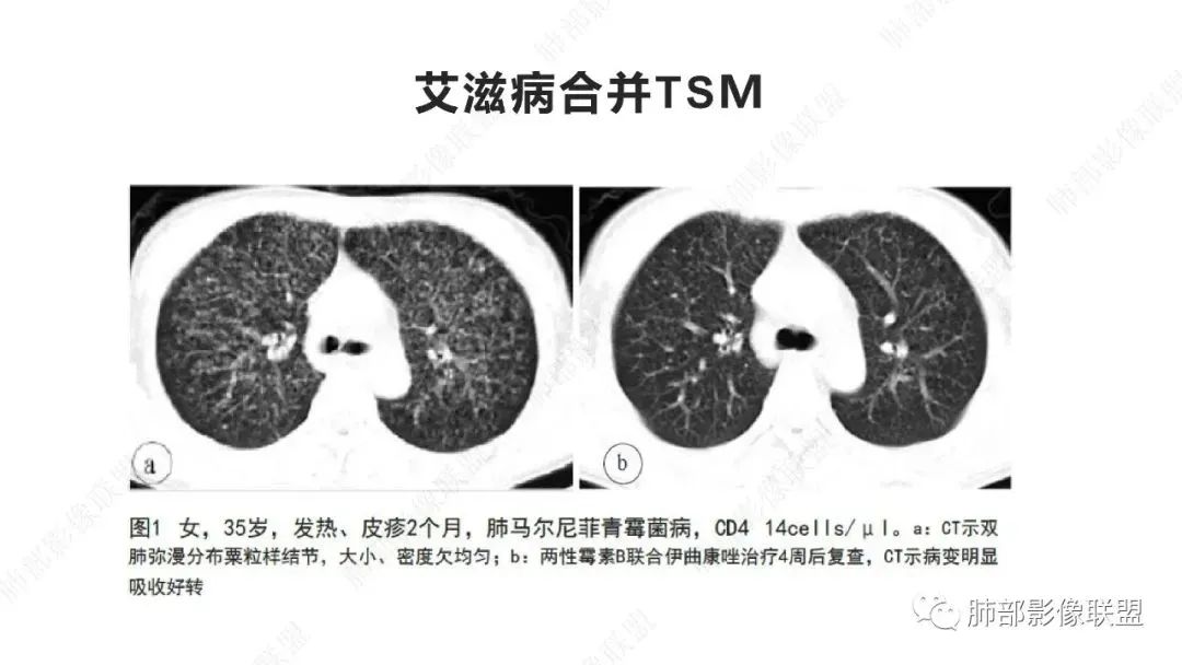 【PPT】马尔尼菲篮状菌的CT表现-11