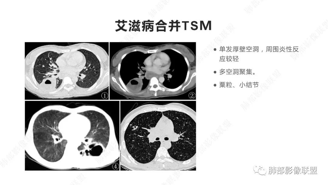 【PPT】马尔尼菲篮状菌的CT表现-12
