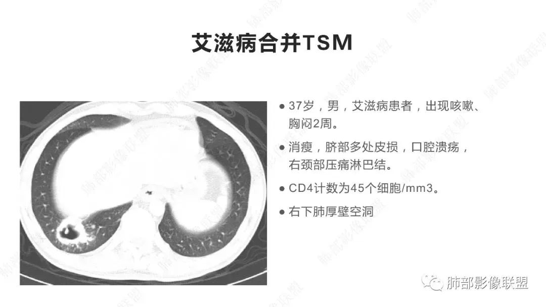 【PPT】马尔尼菲篮状菌的CT表现-13