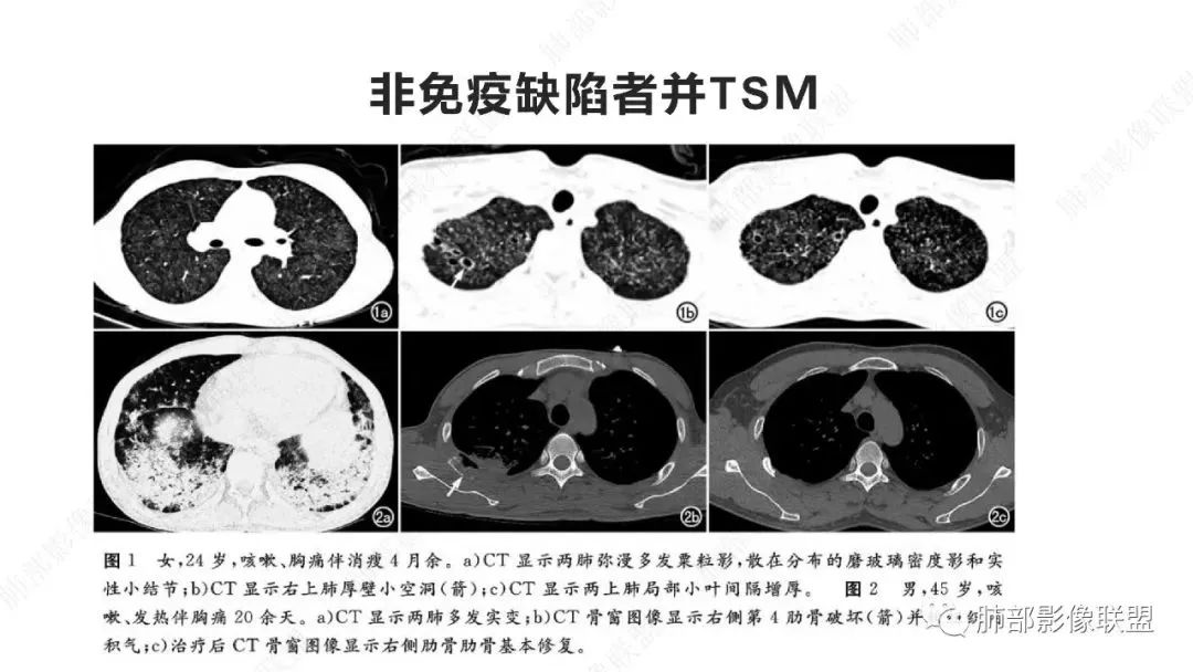【PPT】马尔尼菲篮状菌的CT表现-15