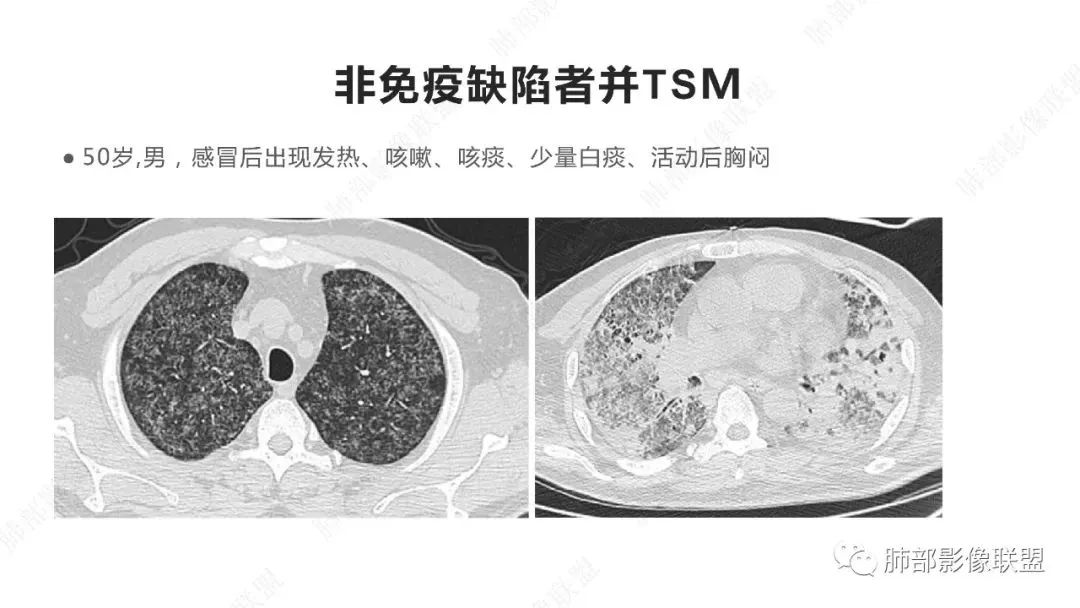 【PPT】马尔尼菲篮状菌的CT表现-16 【PPT】马尔尼菲篮状菌的CT表现-16