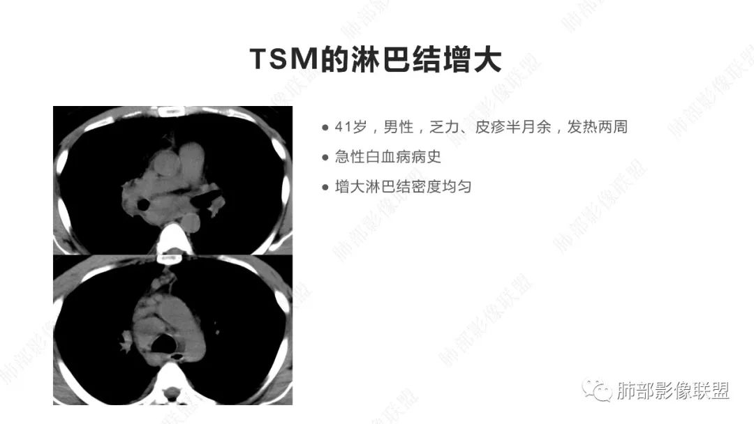 【PPT】马尔尼菲篮状菌的CT表现-18 【PPT】马尔尼菲篮状菌的CT表现-18