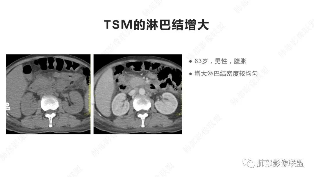 【PPT】马尔尼菲篮状菌的CT表现-19