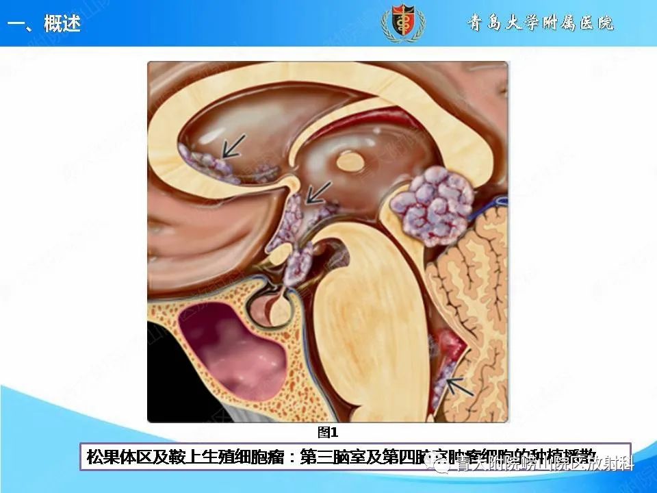 【PPT】颅内生殖细胞瘤的影像学诊断-8