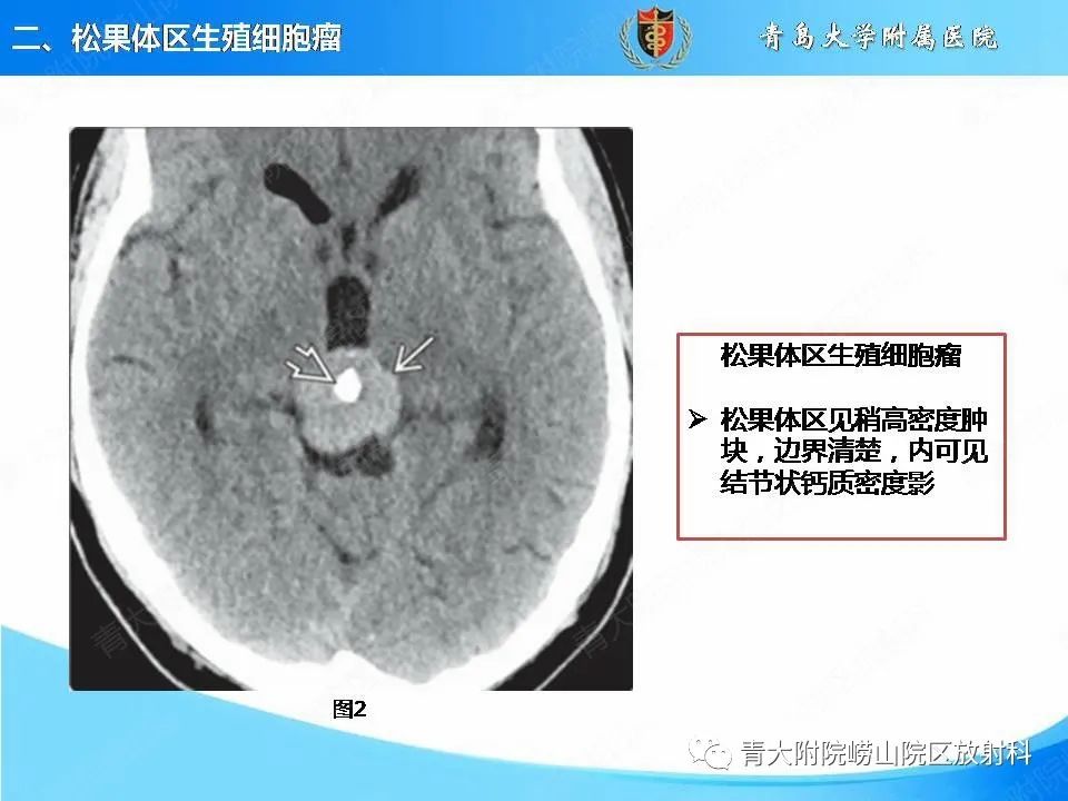 【PPT】颅内生殖细胞瘤的影像学诊断-10