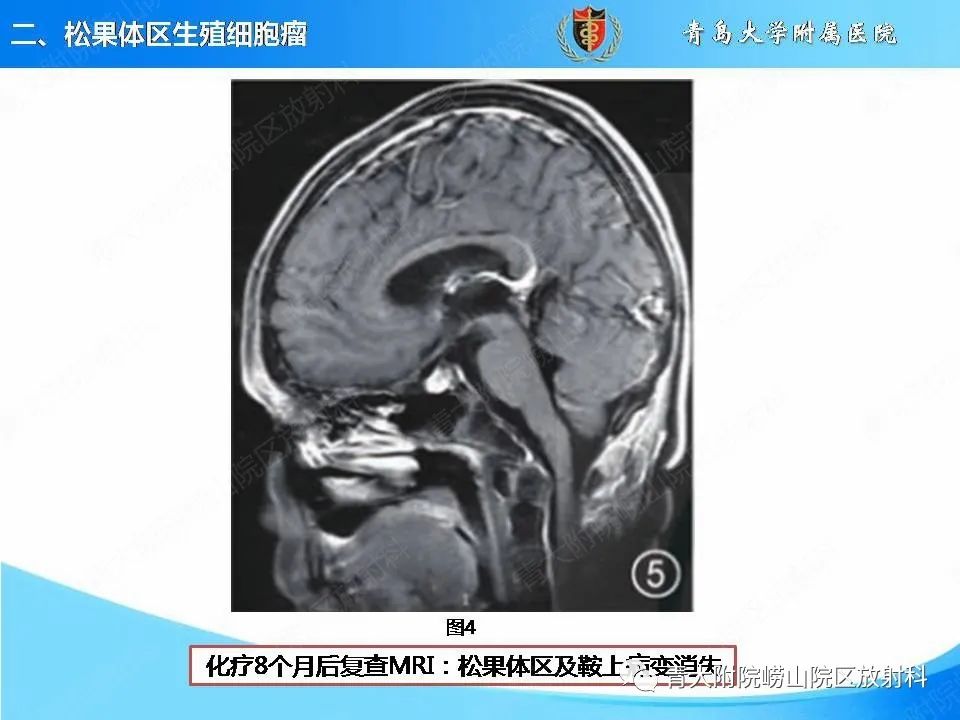 【PPT】颅内生殖细胞瘤的影像学诊断-12