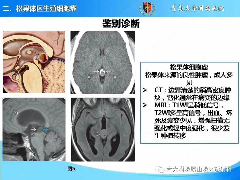 【PPT】颅内生殖细胞瘤的影像学诊断-13