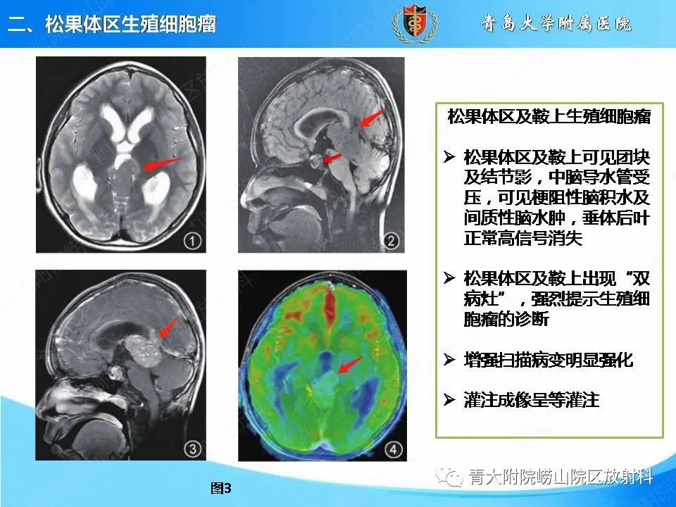 【PPT】颅内生殖细胞瘤的影像学诊断-11