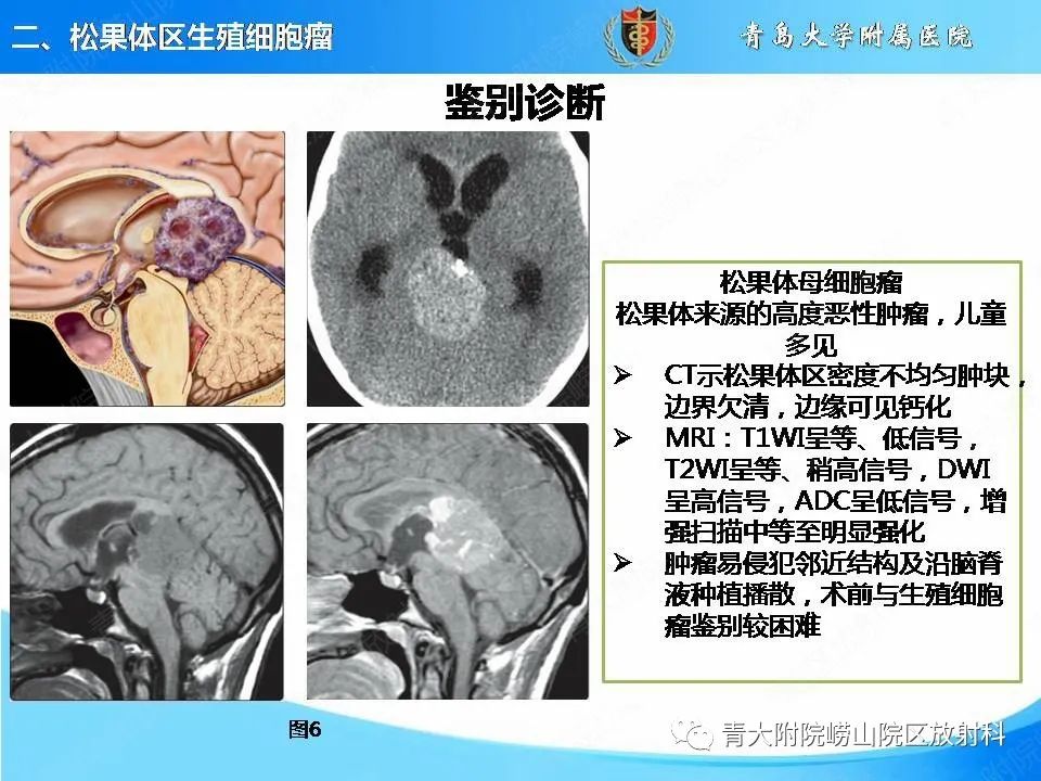 【PPT】颅内生殖细胞瘤的影像学诊断-14