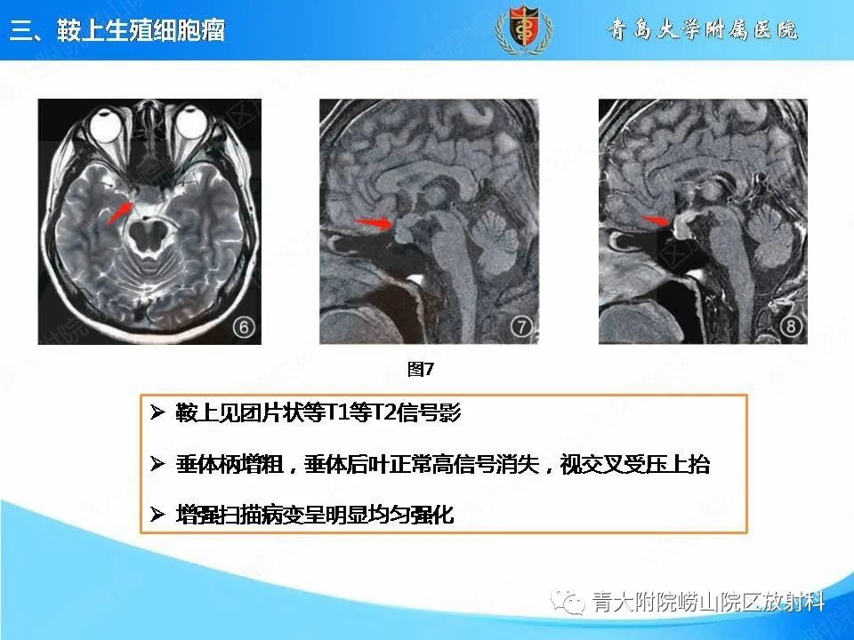 【PPT】颅内生殖细胞瘤的影像学诊断-17