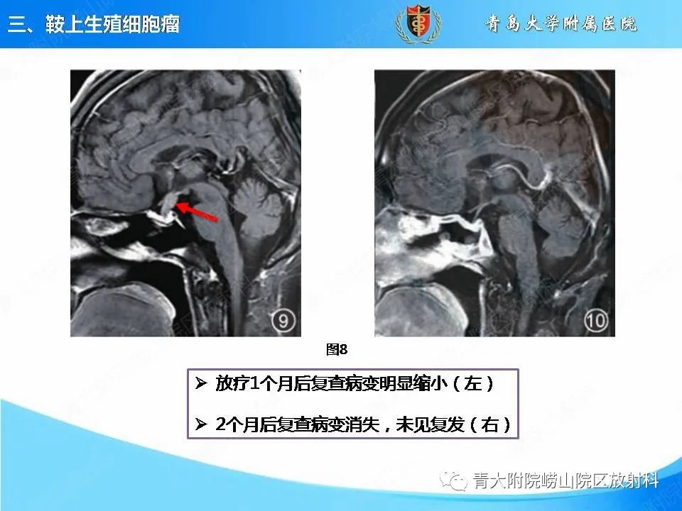【PPT】颅内生殖细胞瘤的影像学诊断-18