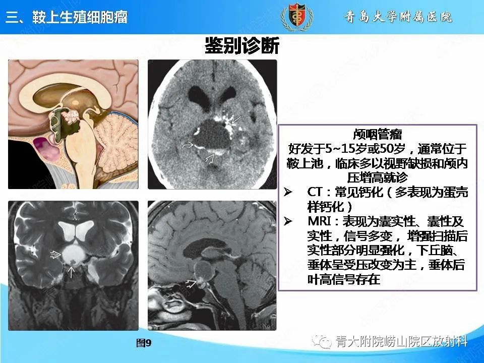 【PPT】颅内生殖细胞瘤的影像学诊断-19
