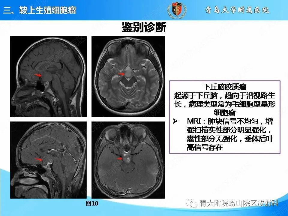 【PPT】颅内生殖细胞瘤的影像学诊断-20