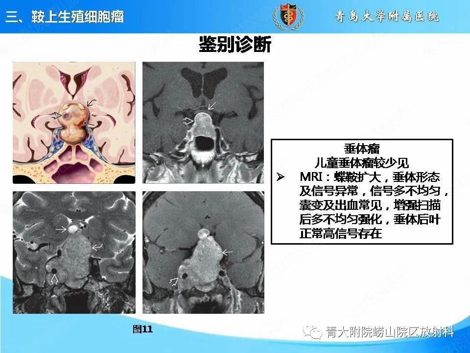 【PPT】颅内生殖细胞瘤的影像学诊断-21