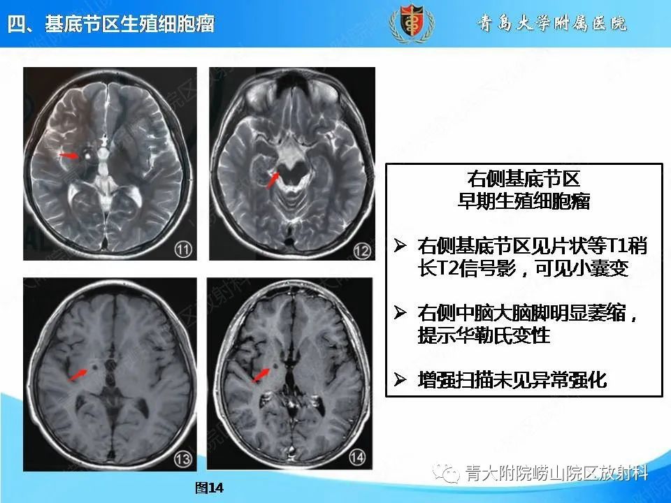 【PPT】颅内生殖细胞瘤的影像学诊断-25