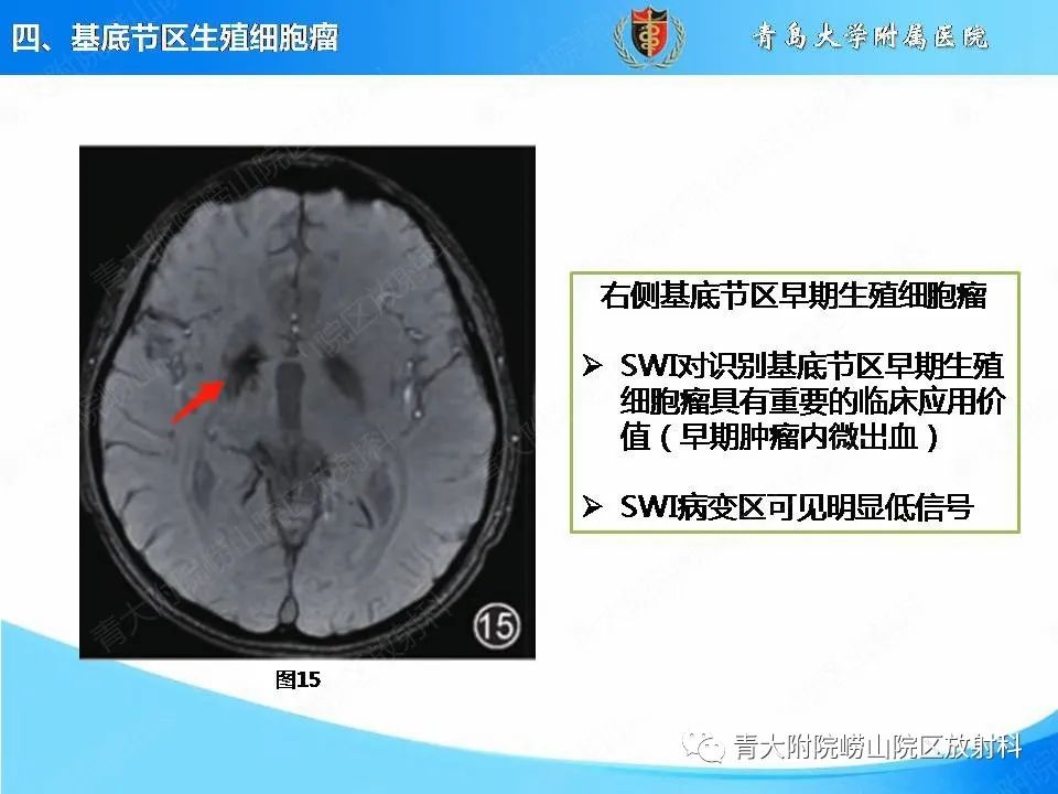 【PPT】颅内生殖细胞瘤的影像学诊断-26