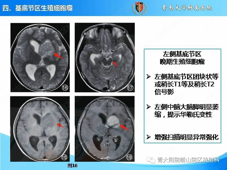 【PPT】颅内生殖细胞瘤的影像学诊断-27