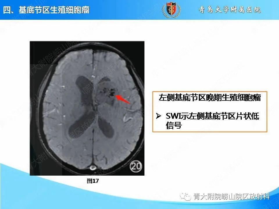 【PPT】颅内生殖细胞瘤的影像学诊断-28
