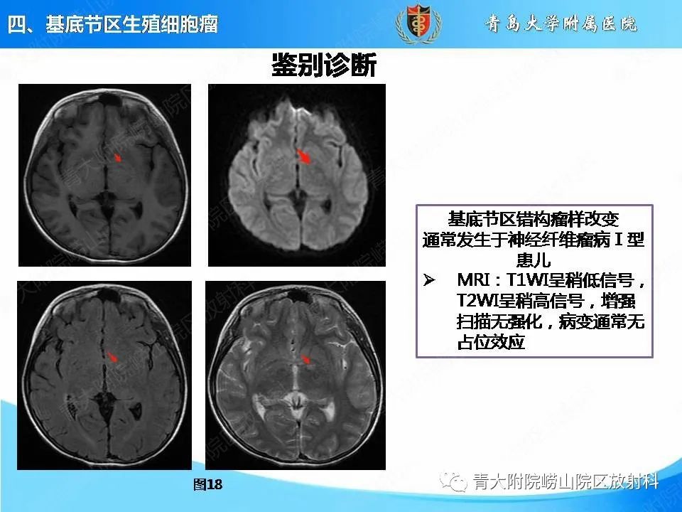 【PPT】颅内生殖细胞瘤的影像学诊断-29