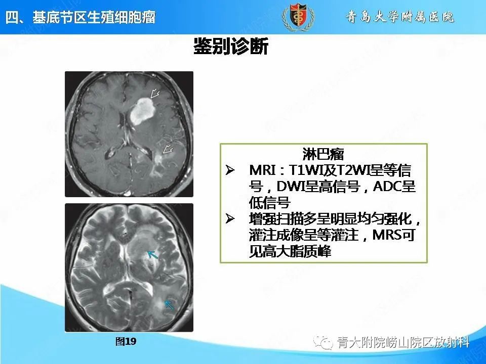 【PPT】颅内生殖细胞瘤的影像学诊断-30