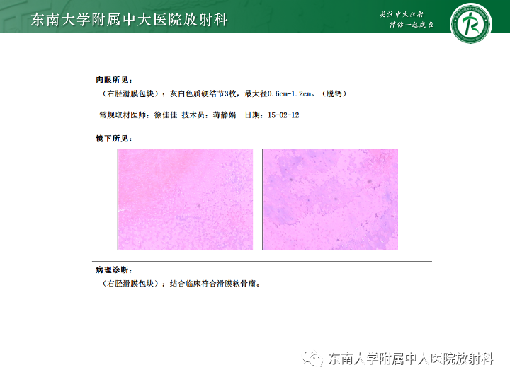 【PPT】滑膜软骨瘤病-4