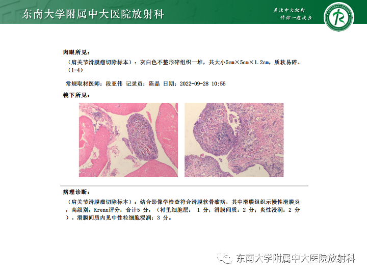 【PPT】滑膜软骨瘤病-2