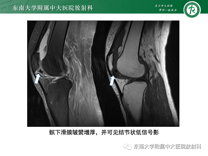 【PPT】滑膜软骨瘤病-18