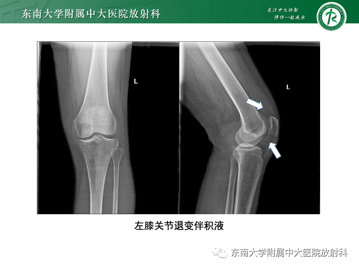 【PPT】滑膜软骨瘤病-20