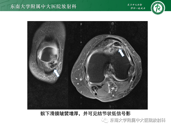 【PPT】滑膜软骨瘤病-19