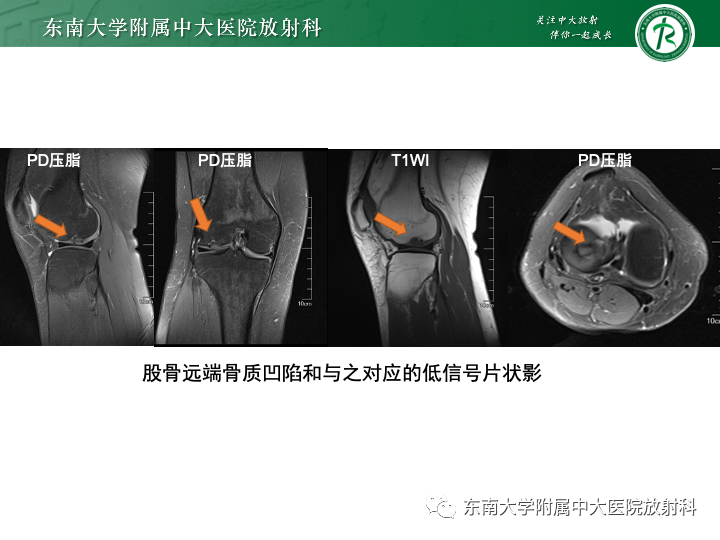 【PPT】滑膜软骨瘤病-22