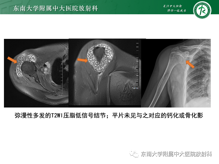 【PPT】滑膜软骨瘤病-25