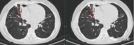 支气管扩张：印戒征+轨道征-2