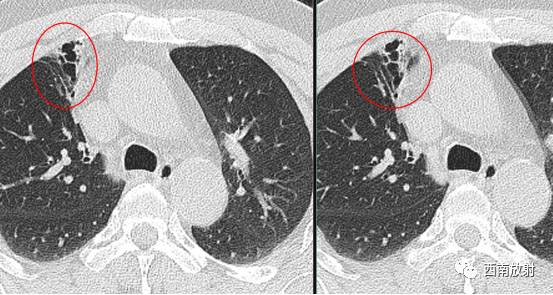 支气管扩张：印戒征+轨道征-5