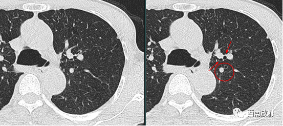 支气管扩张：印戒征+轨道征-1
