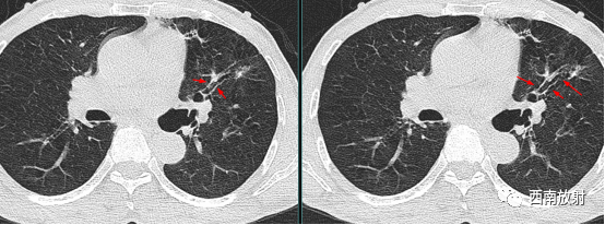 支气管扩张：印戒征+轨道征-3