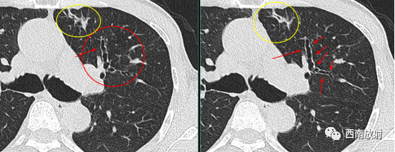 支气管扩张：印戒征+轨道征-4